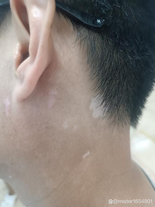 萎缩性白斑能治愈吗?,萎缩性白斑是不是最难治疗