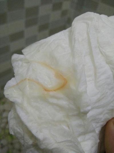 用了卡波姆排出一坨白色东西,用了卡波姆排出一坨白色东西带血丝